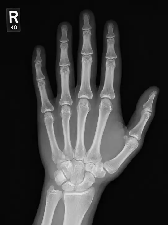 Create realistic x-ray image of human hand. Use aspect ratio 3:4.